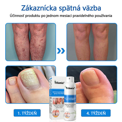 Oficiálny obchod✨: Trilumia®Horčíkový bylinný sprej na psoriázu⚕️certifikované FDA (úľava od psoriázy a ekzému, zlepšenie bakteriálnych infekcií v oblasti genitálií a liečba akné a tmavých škvŕn)