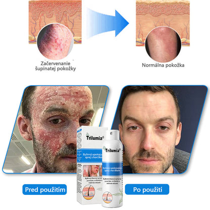 Oficiálny obchod✨: Trilumia®Horčíkový bylinný sprej na psoriázu⚕️certifikované FDA (úľava od psoriázy a ekzému, zlepšenie bakteriálnych infekcií v oblasti genitálií a liečba akné a tmavých škvŕn)