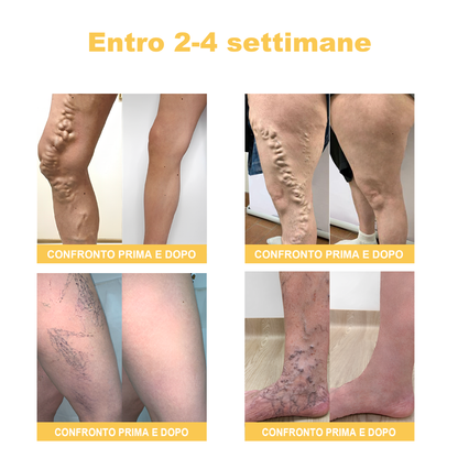 🏆[✨Negozio ufficiale del marchio✨]Zoencgz™ Crema al veleno d'api  per artrite e vene varicose
