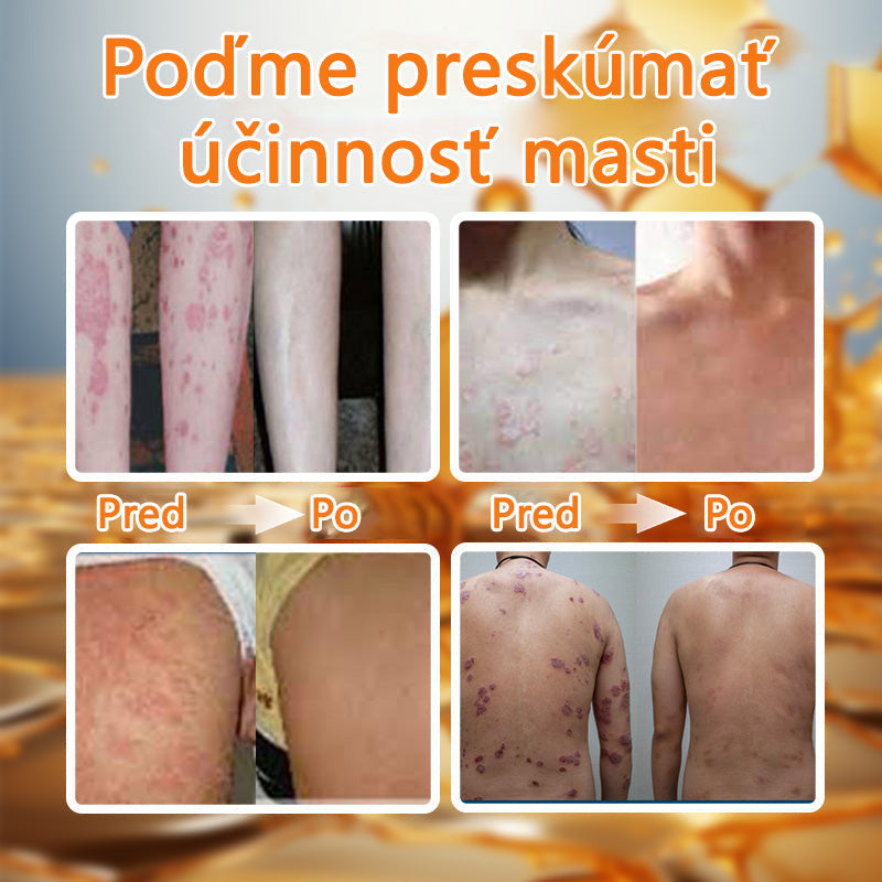 🌿Pokročilá masť na liečbu psoriázy Ourlyard™ (👨‍⚕Odporúčané lekárom) je certifikovaná Slovenským ústavom liečiv a zdravotníckych pomôcok (BFARM) a získala certifikáciu CE.