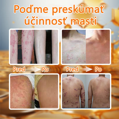 🌿Pokročilá masť na liečbu psoriázy Ourlyard™ (👨‍⚕Odporúčané lekárom) je certifikovaná Slovenským ústavom liečiv a zdravotníckych pomôcok (BFARM) a získala certifikáciu CE.