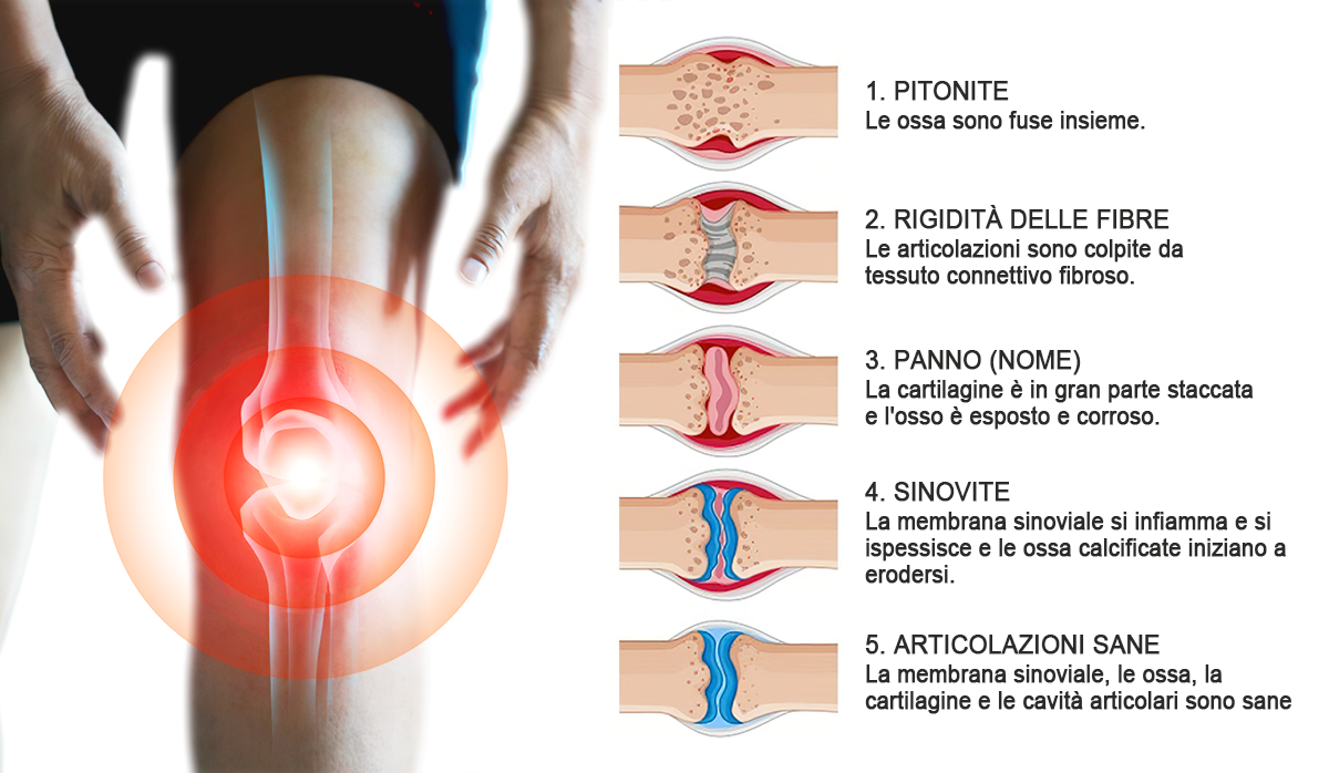 🏆[✨Negozio ufficiale del marchio✨]Zoencgz™ Crema al veleno d'api  per artrite e vene varicose