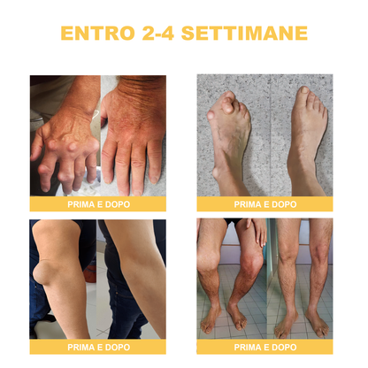 🏆[✨Negozio ufficiale del marchio✨]Zoencgz™ Crema al veleno d'api  per artrite e vene varicose
