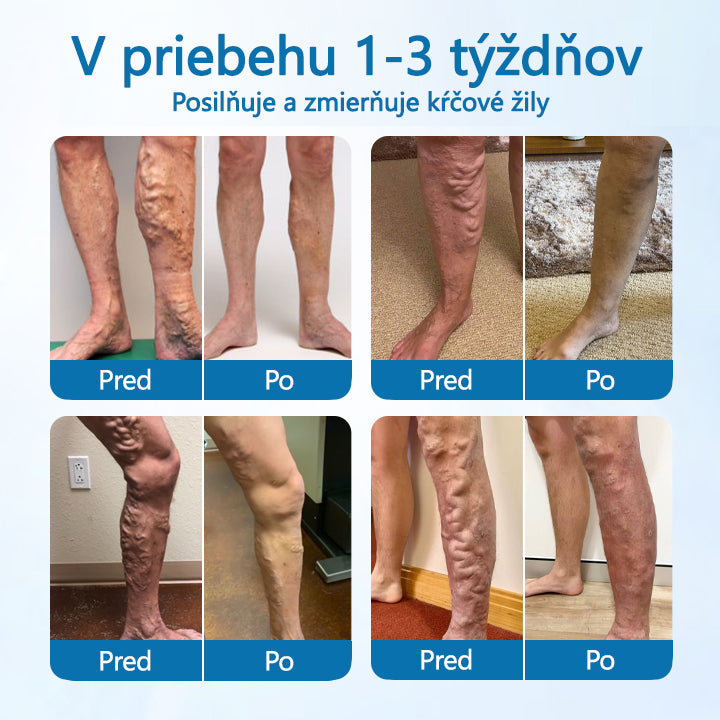 🌿🌿 Timilk® VeinGuard – Bylinný sprej na kŕčové žily s preukázanou účinnosťou už za 7 dní!