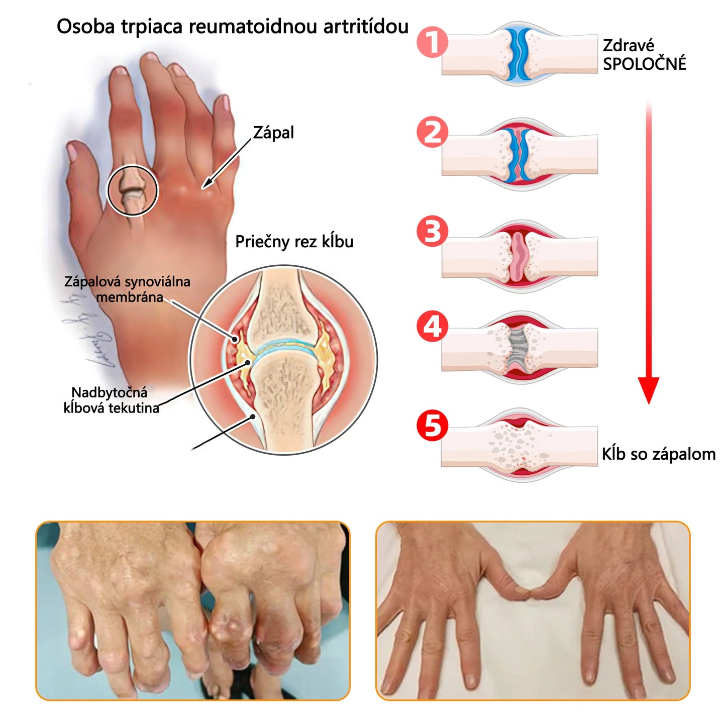 Foulme® Krém na hojenie kostí s botulotoxínom a včelím jedom ⭐👨‍⚕️