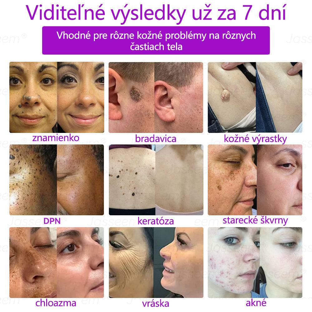 𝐉𝐚𝐬𝐬𝐞𝐞𝐦® Pokročilé neinvazívne CO₂ laserové pero na opravu pokožky 💕 (Jemne odstraňuje bradavice, materské znamienka, starecké škvrny a kožné výrastky – bez bolesti, bez starostí!)