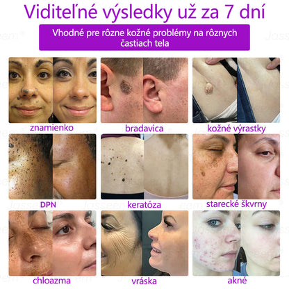 𝐉𝐚𝐬𝐬𝐞𝐞𝐦® Pokročilé neinvazívne CO₂ laserové pero na opravu pokožky 💕 (Jemne odstraňuje bradavice, materské znamienka, starecké škvrny a kožné výrastky – bez bolesti, bez starostí!)
