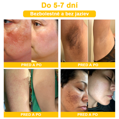 2024 NOVINKA Velisse™ Pleťový krém s včelím jedom(🧑‍⚕️Odporúča sa AAD), na odstránenie bradavíc, akné a jaziev – lieči viaceré kožné stavy