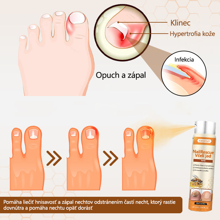 2025🎁 Limitovaná akcia 70% ZĽAVA ️ ️⏳ Ceoerty® Sprej na nechtovú hubu s včelím jedom 💥 Oprava všetkých problémov s nechtami do 2 týždňov