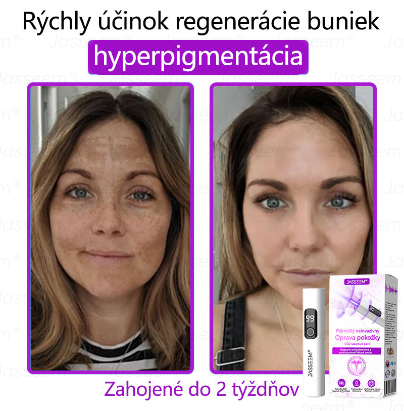 𝐉𝐚𝐬𝐬𝐞𝐞𝐦® Pokročilé neinvazívne CO₂ laserové pero na opravu pokožky 💕 (Jemne odstraňuje bradavice, materské znamienka, starecké škvrny a kožné výrastky – bez bolesti, bez starostí!)