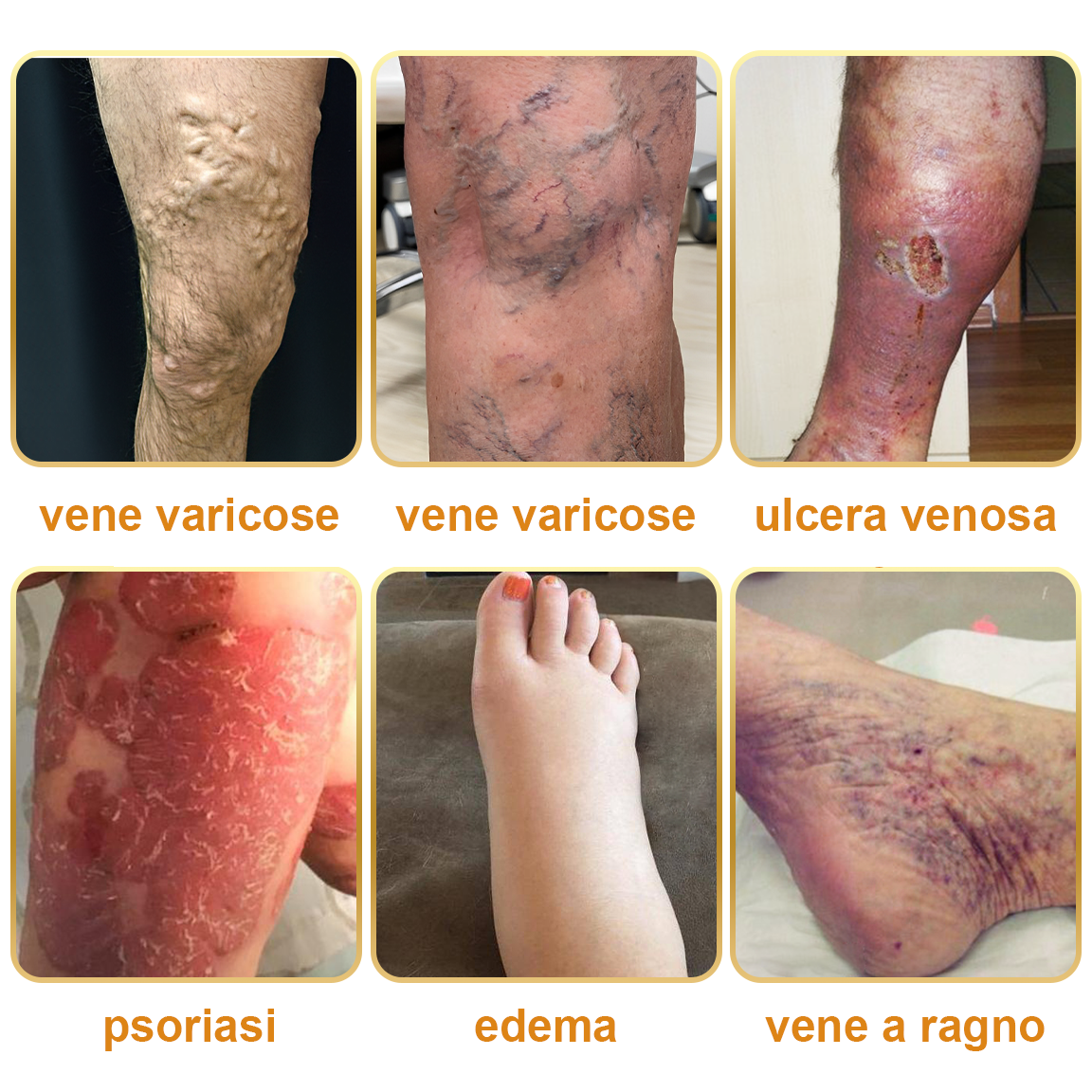 🏆[✨Negozio ufficiale del marchio✨]Zoencgz™ Crema al veleno d'api  per artrite e vene varicose