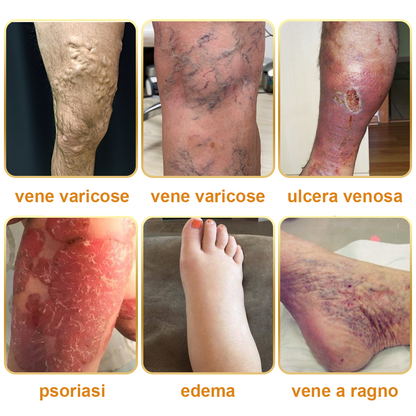 🏆[✨Negozio ufficiale del marchio✨]Zoencgz™ Crema al veleno d'api  per artrite e vene varicose