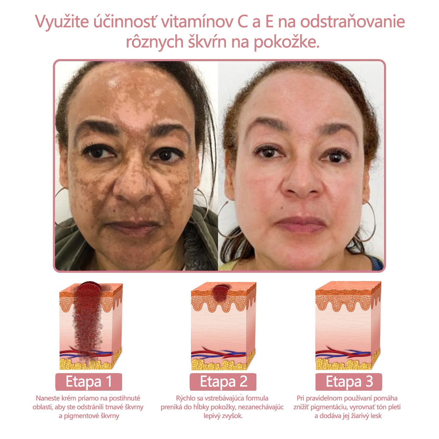 Krém na pleťskolagénom akoenzýmom Q10 v gélovej forme, schválený Slovenskou dermatologickou spoločnosťou (pomáha pri liečbe akné, bradavíc, ružovky, psoriázy, stareckých škvŕn, ekzémov a znižuje výskyt strií).