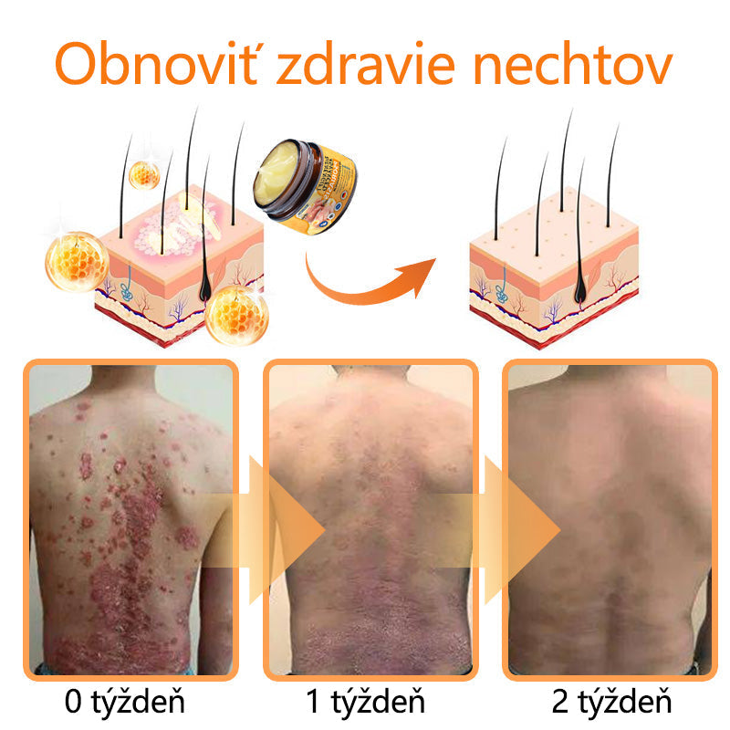 🌿Pokročilá masť na liečbu psoriázy Ourlyard™ (👨‍⚕Odporúčané lekárom) je certifikovaná Slovenským ústavom liečiv a zdravotníckych pomôcok (BFARM) a získala certifikáciu CE.