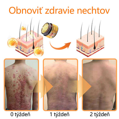 🌿Pokročilá masť na liečbu psoriázy Ourlyard™ (👨‍⚕Odporúčané lekárom) je certifikovaná Slovenským ústavom liečiv a zdravotníckych pomôcok (BFARM) a získala certifikáciu CE.
