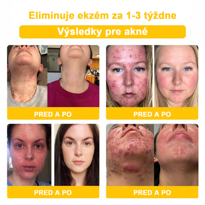 2024 NOVINKA Velisse™ Pleťový krém s včelím jedom(🧑‍⚕️Odporúča sa AAD), na odstránenie bradavíc, akné a jaziev – lieči viaceré kožné stavy