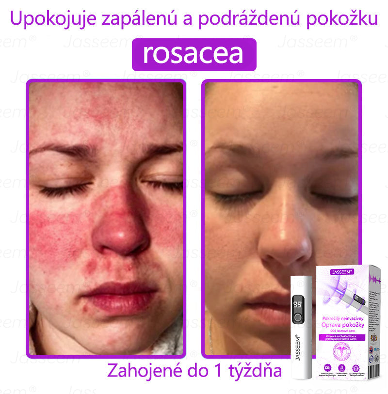 𝐉𝐚𝐬𝐬𝐞𝐞𝐦® Pokročilé neinvazívne CO₂ laserové pero na opravu pokožky 💕 (Jemne odstraňuje bradavice, materské znamienka, starecké škvrny a kožné výrastky – bez bolesti, bez starostí!)