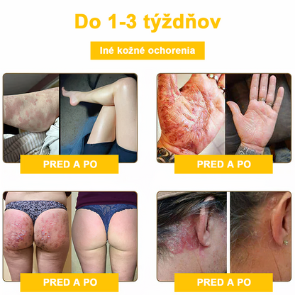 2024 NOVINKA Velisse™ Pleťový krém s včelím jedom(🧑‍⚕️Odporúča sa AAD), na odstránenie bradavíc, akné a jaziev – lieči viaceré kožné stavy