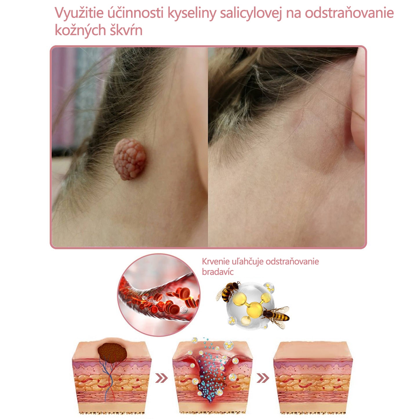 Krém na pleťskolagénom akoenzýmom Q10 v gélovej forme, schválený Slovenskou dermatologickou spoločnosťou (pomáha pri liečbe akné, bradavíc, ružovky, psoriázy, stareckých škvŕn, ekzémov a znižuje výskyt strií).