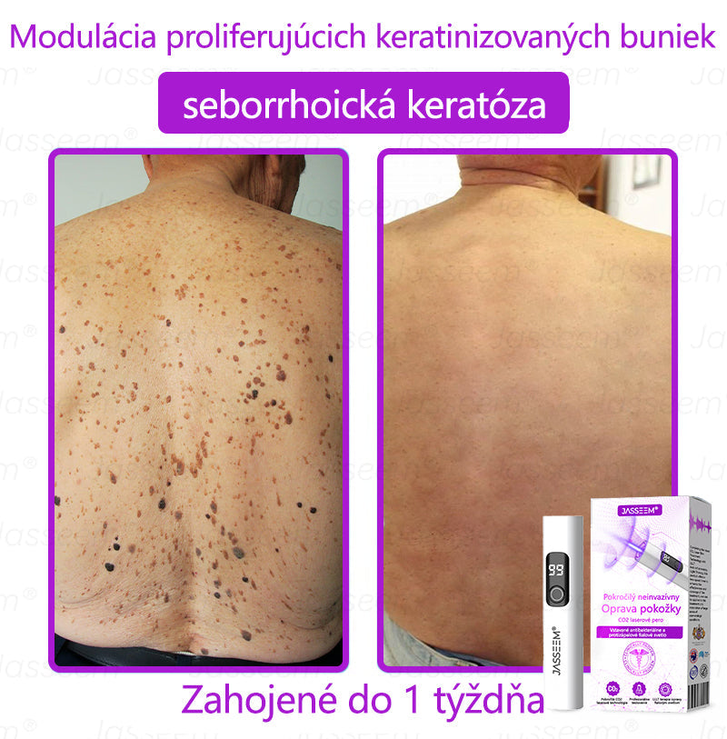 𝐉𝐚𝐬𝐬𝐞𝐞𝐦® Pokročilé neinvazívne CO₂ laserové pero na opravu pokožky 💕 (Jemne odstraňuje bradavice, materské znamienka, starecké škvrny a kožné výrastky – bez bolesti, bez starostí!)