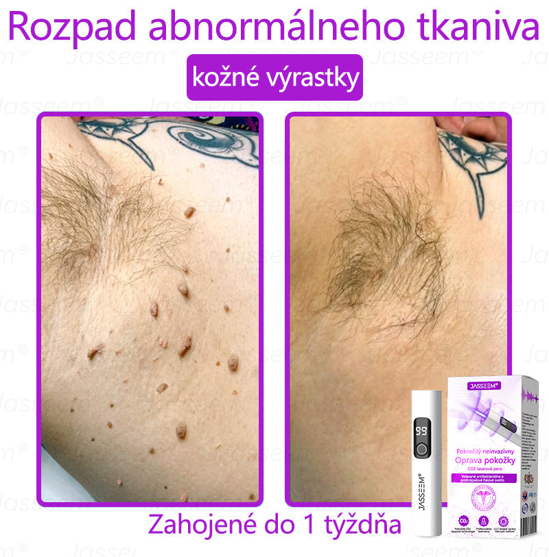 𝐉𝐚𝐬𝐬𝐞𝐞𝐦® Pokročilé neinvazívne CO₂ laserové pero na opravu pokožky 💕 (Jemne odstraňuje bradavice, materské znamienka, starecké škvrny a kožné výrastky – bez bolesti, bez starostí!)