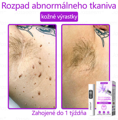 𝐉𝐚𝐬𝐬𝐞𝐞𝐦® Pokročilé neinvazívne CO₂ laserové pero na opravu pokožky 💕 (Jemne odstraňuje bradavice, materské znamienka, starecké škvrny a kožné výrastky – bez bolesti, bez starostí!)