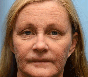 🍀👩‍⚕️Získajte mladistvú pleť hneď teraz! - 👩‍⚕️Furzero™ Botoxový krém na odstraňovanie vrások s obsahom včelieho jedu - (posledný deň 70% zľava)